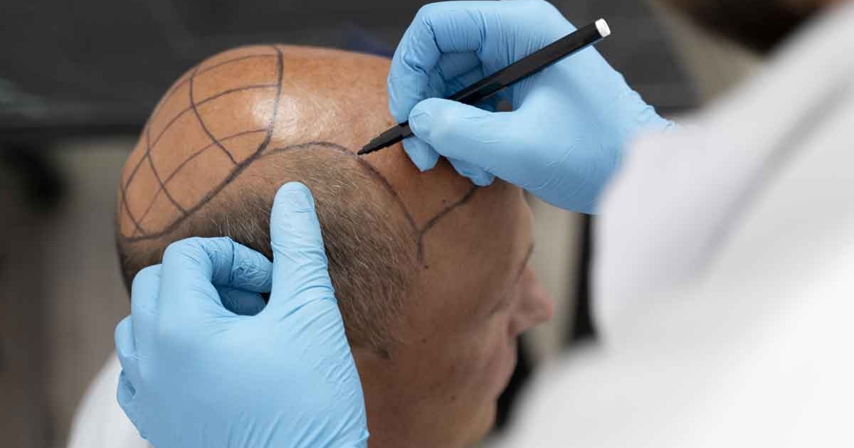 male-going-through-follicular-unit-extraction-process