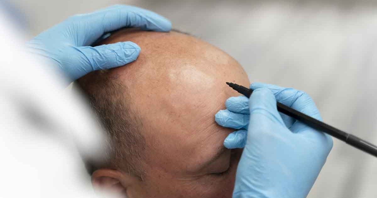 man-going-through-follicular-unit-extraction-process-(1)