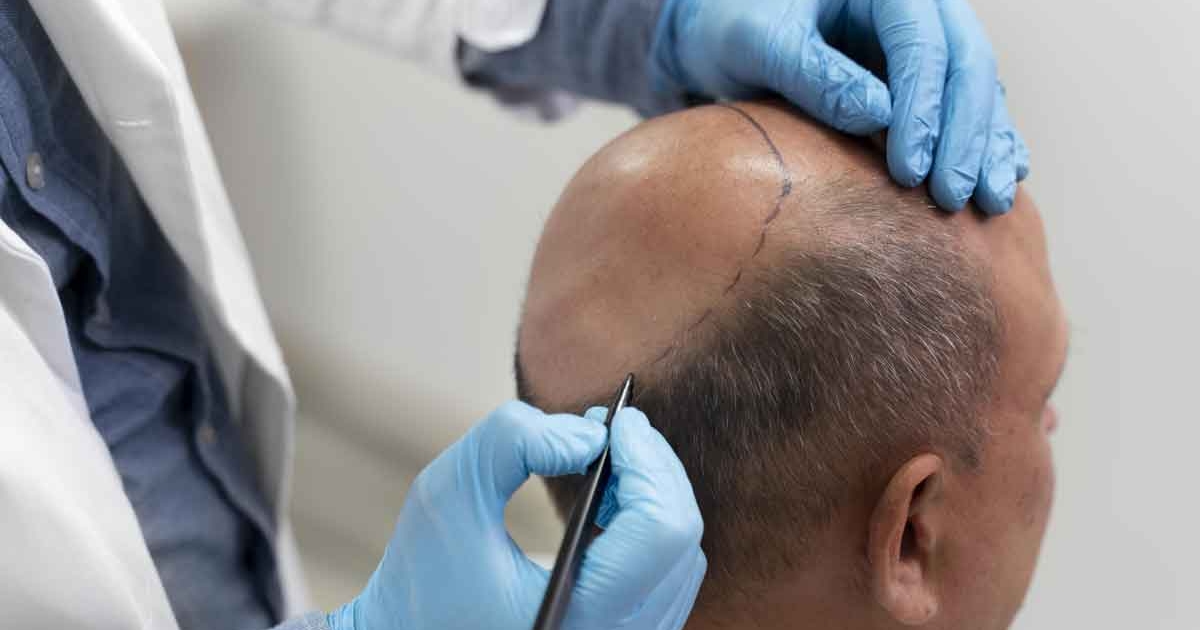 man-going-through-follicular-unit-extraction-process